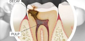 root canal