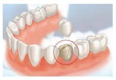 dental crown