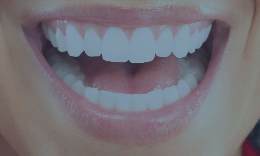 Teeth Whitening